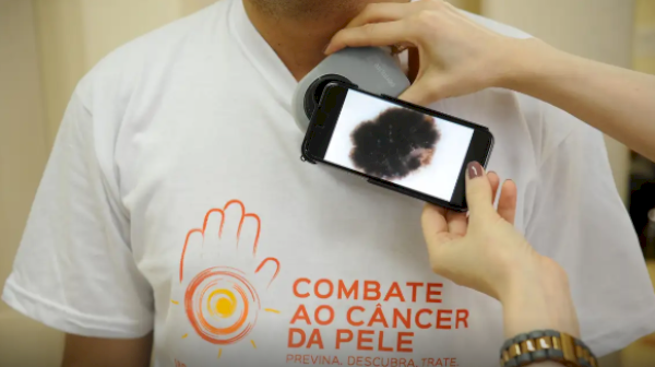 Mutirão atende população hoje, no dia de combate ao câncer de pele